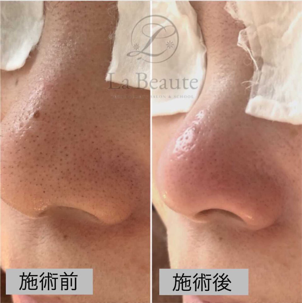 毛穴エクストラクションビフォーアフター