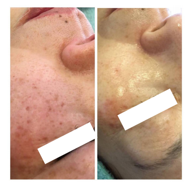 ALICIA シミデトックス